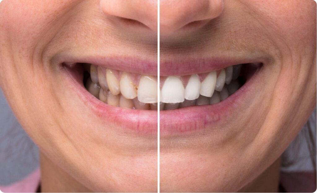 before after white teeth